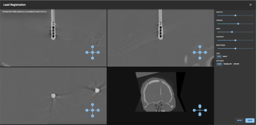 Deep Brain Stimulation Visual Programming